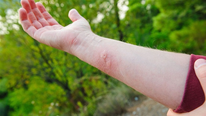 treat-insect-bites-prevent-infection-disease-1440x810.jpg